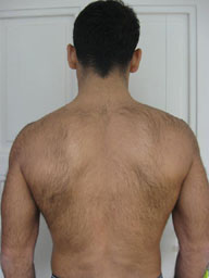 hairy back